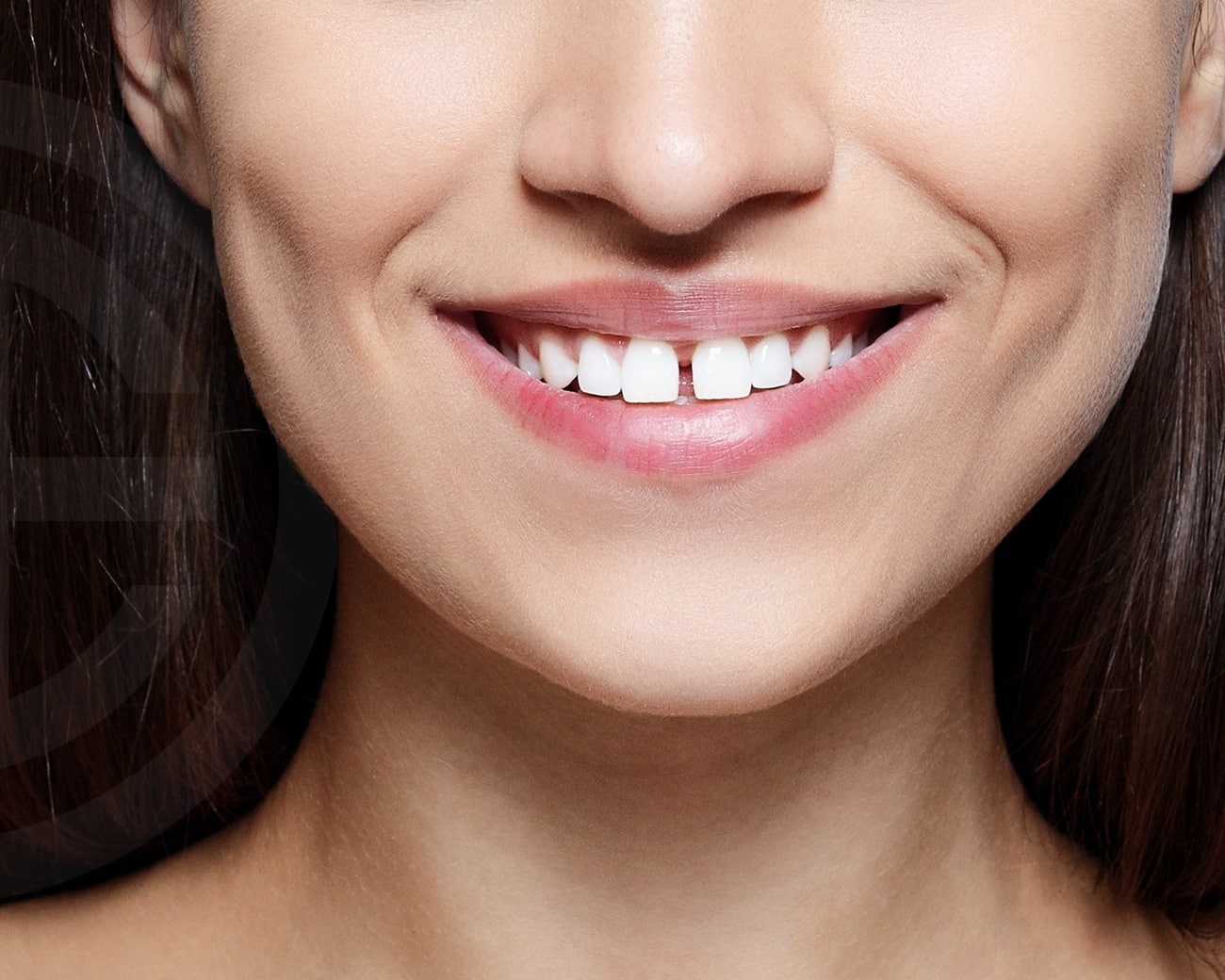 Dents écartées : les causes et les traitements dentaires | Dr Elhyani | Paris