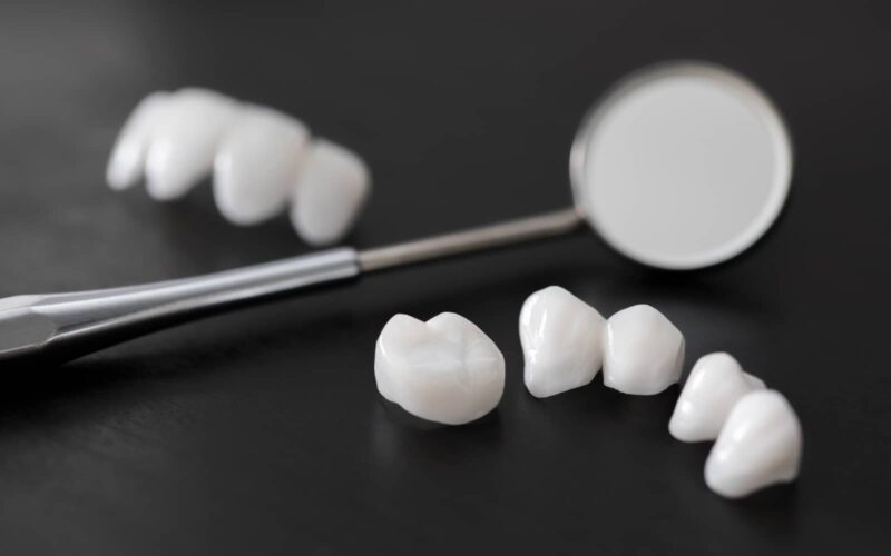 Quelle est la différence entre facette dentaire et couronne ? | Dr Elhyani | Paris