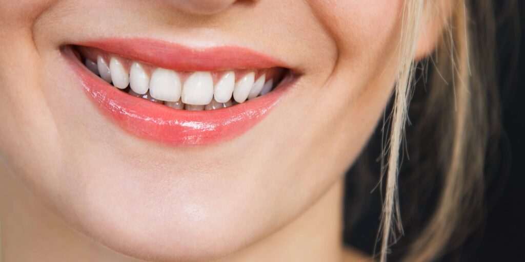 Mes dents ont bougé après un traitement orthodontique que faire ? Dr Elhyani Paris