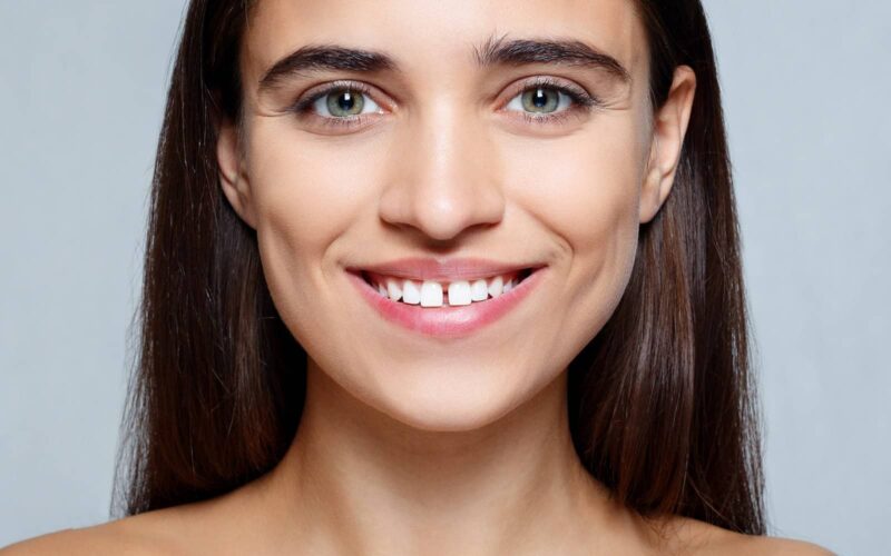 Les facettes dentaires : une solution pour corriger les dents du bonheur | Dr Elhyani | Paris