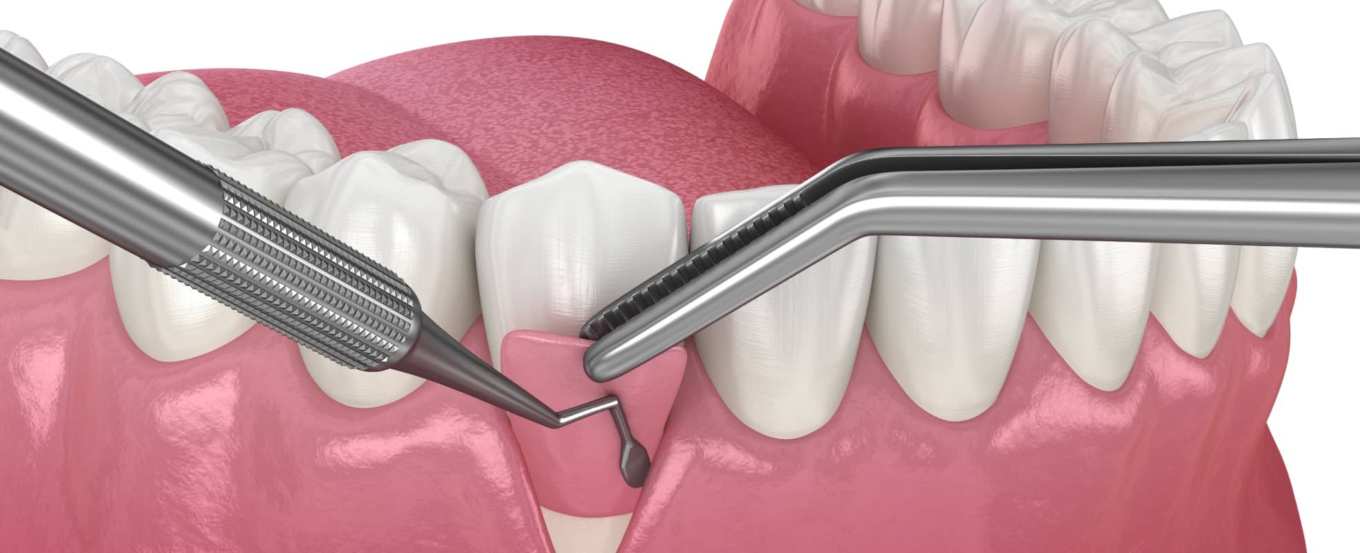 Quand est-ce que la greffe osseuse dentaire est nécessaire pour la pose d'implants dentaires ? | Dr Elhyani | Paris