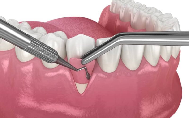 Quand est-ce que la greffe osseuse dentaire est nécessaire pour la pose d'implants dentaires ? | Dr Elhyani | Paris