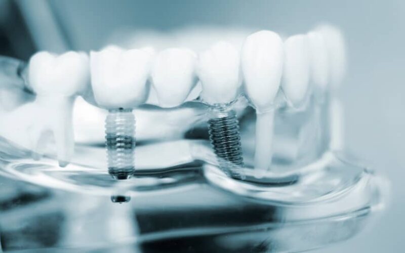 Comment se déroule la pose d’un implant dentaire ? | Dr Elhyani | Paris