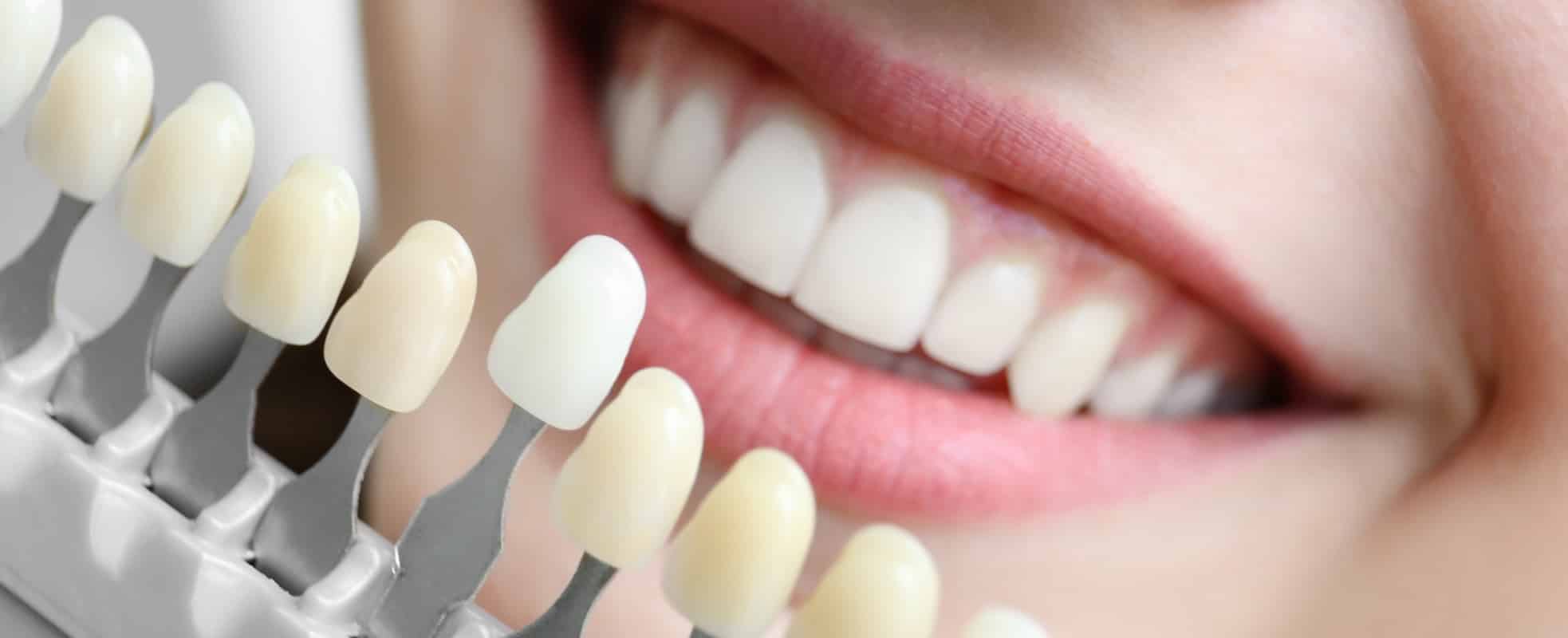 Le blanchiment dentaire est-il adapté à tout le monde ? | Dr Elhyani | Paris