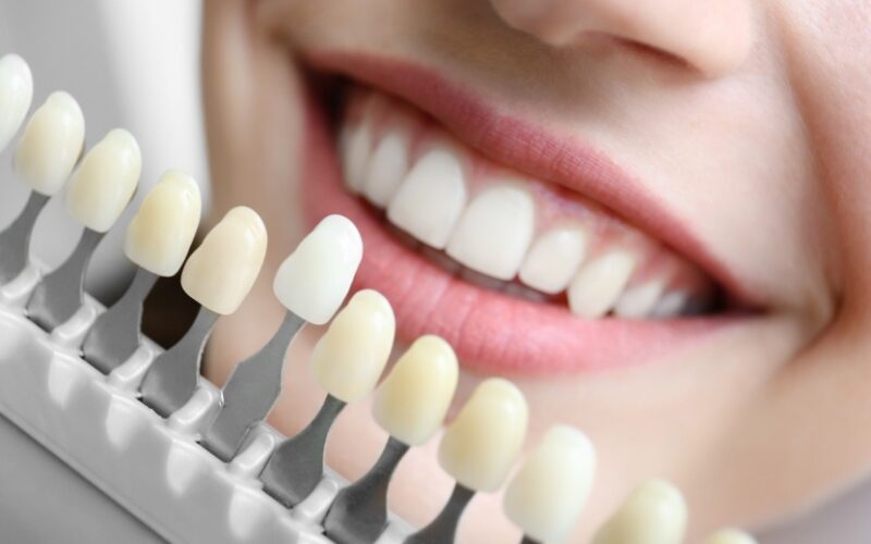 Le blanchiment dentaire est-il adapté à tout le monde ? | Dr Elhyani | Paris