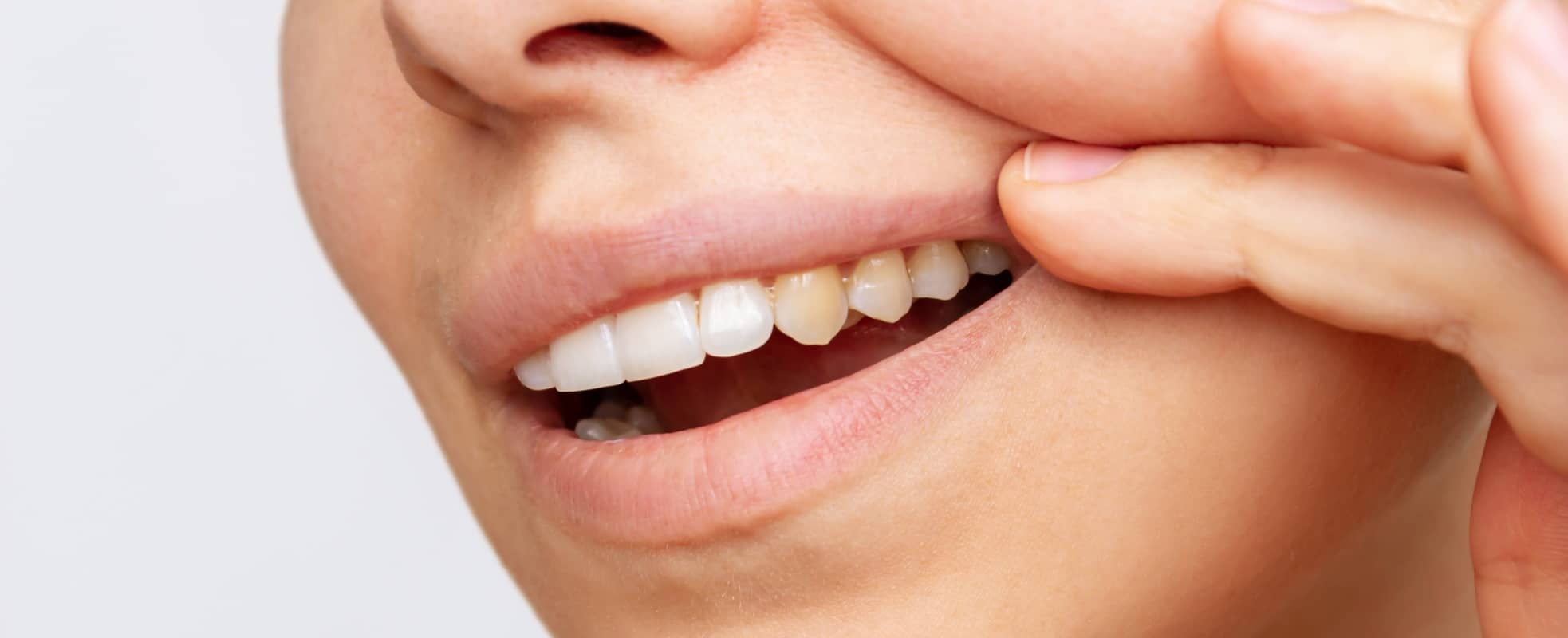 J'ai les dents jaunes : quelle est la meilleure solution entre des facettes dentaires ou un blanchiment des dents ? | Dr Elhyani | Paris