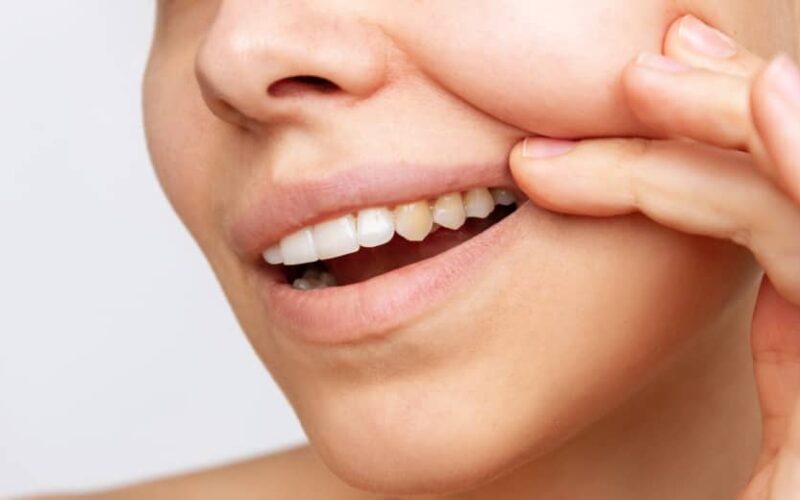 J'ai les dents jaunes : quelle est la meilleure solution entre des facettes dentaires ou un blanchiment des dents ? | Dr Elhyani | Paris