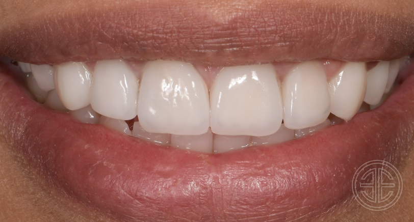 Résultats avant/apres facettes dentaires | Dr Elhyani | Paris