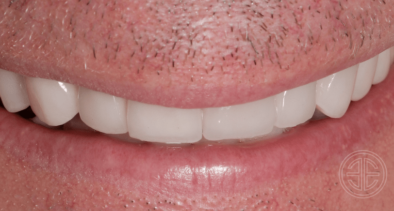 Photo apres facettes dentaires | Dr Elhyani | Paris