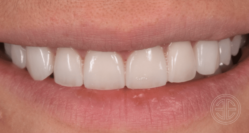Apres facettes dentaires | Dr Elhyani| Paris