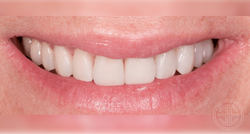 avant/apres facettes dentaires | Dr Elhyani | Paris