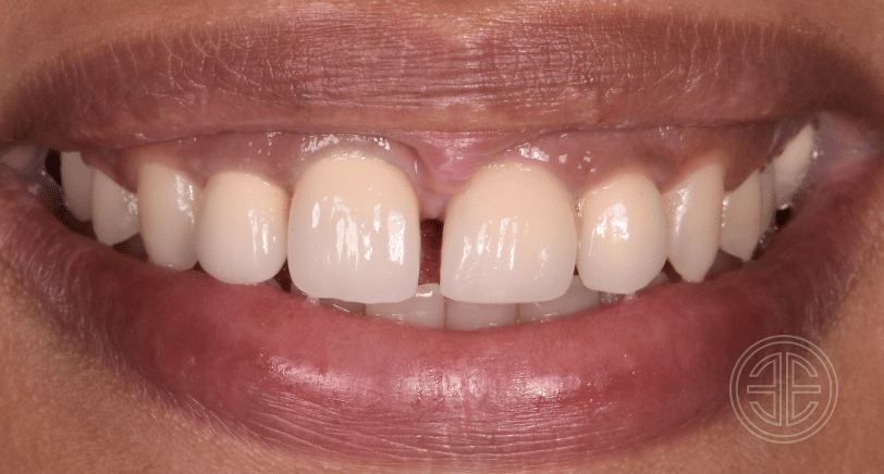 facettes dentaires-avant-10-sana-oris