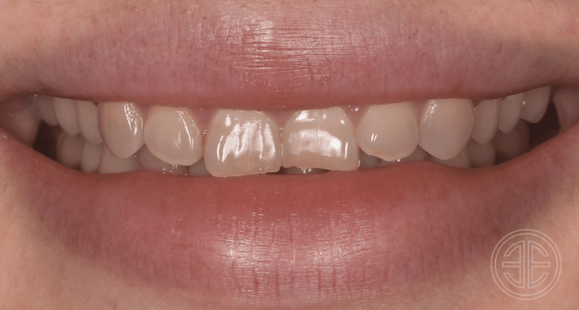 facettes dentaires | Dr Elhyani |Paris