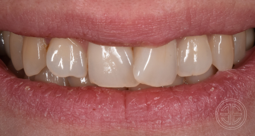 Avant facettes dentaires | Dr Elhyani | Paris