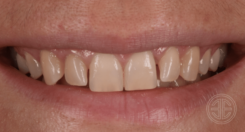Facettes dentaires | Dr Elhyani| Paris