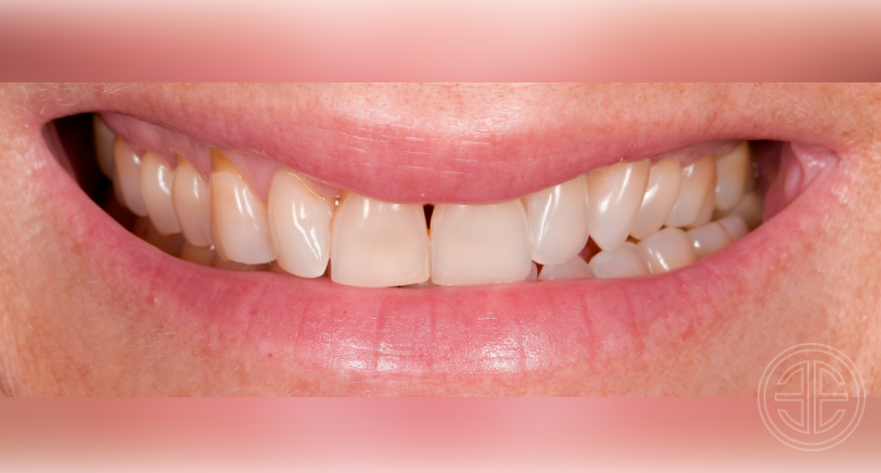 avant/apres facettes dentaires | Dr Ari Elhyani | Paris