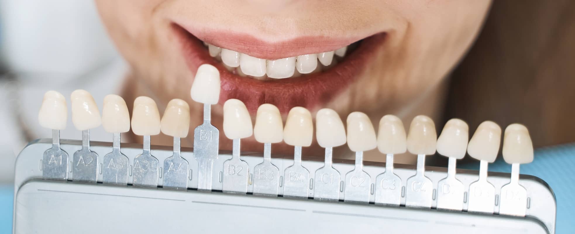 Quel est l'avantage des facettes dentaires par rapport au blanchiment dentaire ? | Dr Elhyani | Paris