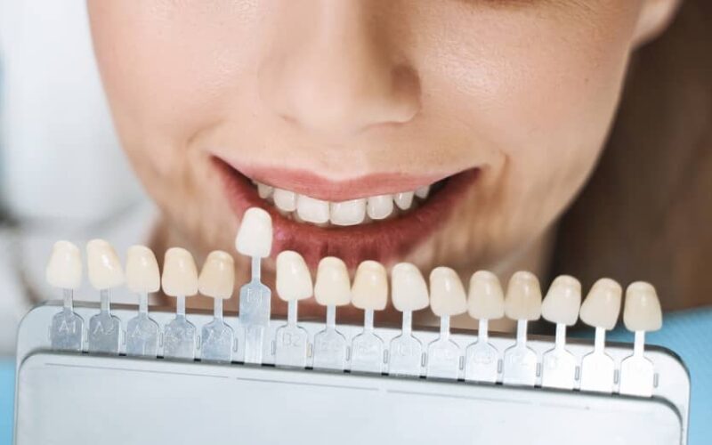 Quel est l'avantage des facettes dentaires par rapport au blanchiment dentaire ? | Dr Elhyani | Paris