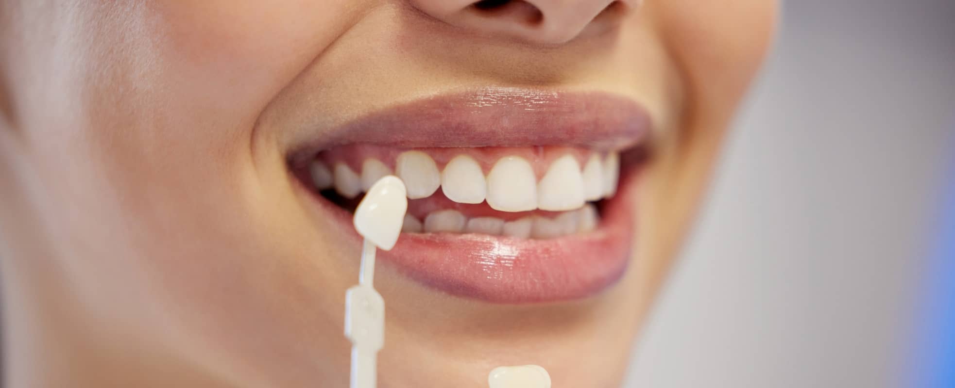 Quand se faire poser des facettes dentaires ? | Dr Elhyani | Paris