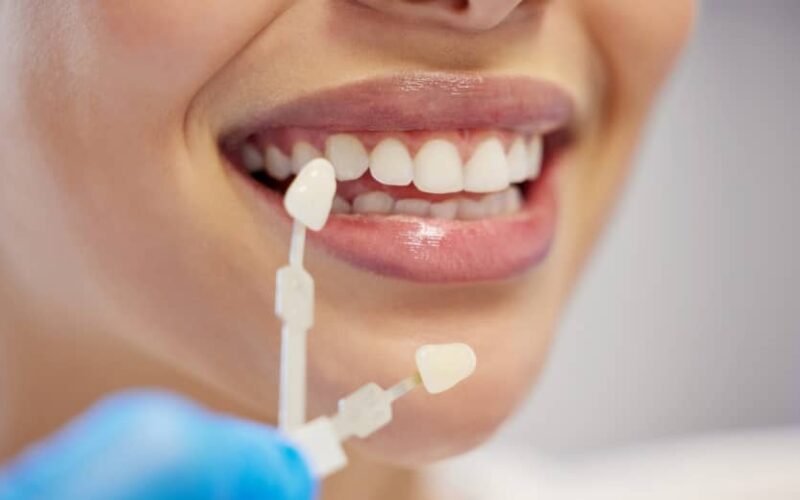 Quand se faire poser des facettes dentaires ? | Dr Elhyani | Paris
