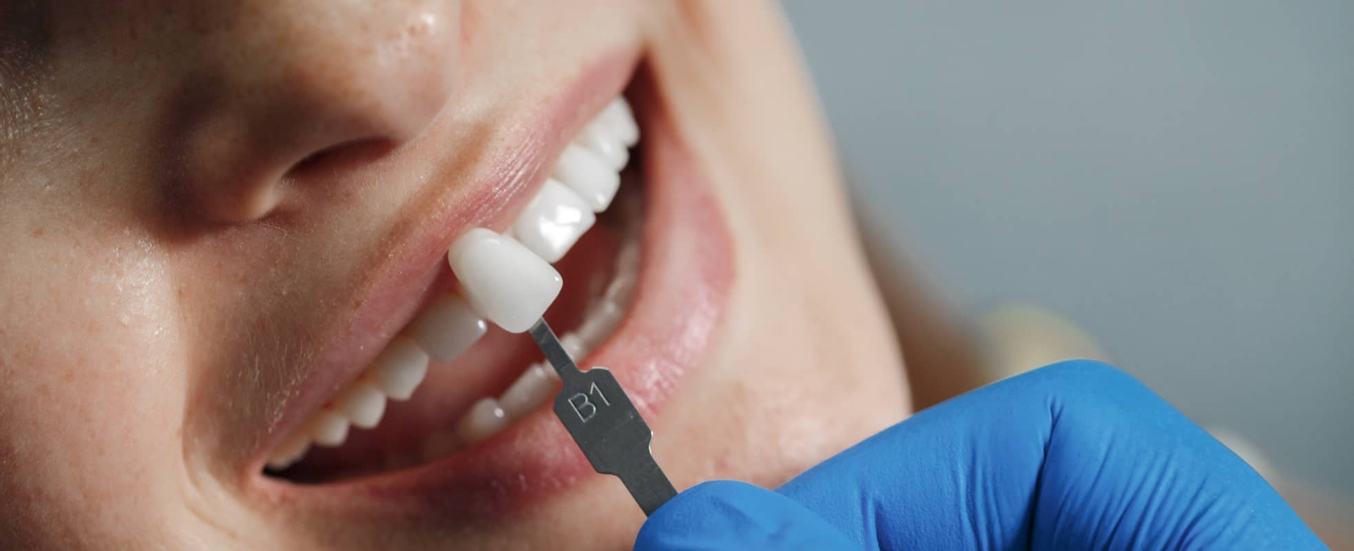 Pourquoi retirer ses facettes dentaires ? | Dr Elhyani | Paris